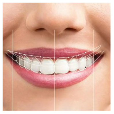 Digital Smile Design(Gülüş Tasarımı)